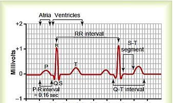 Image of ECG readout